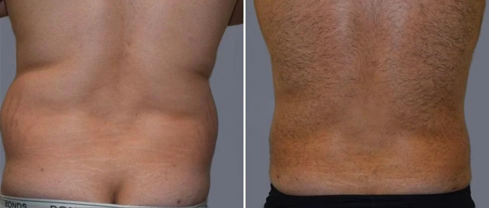 vaser back liposcution male pre2024 017 before and after before and after