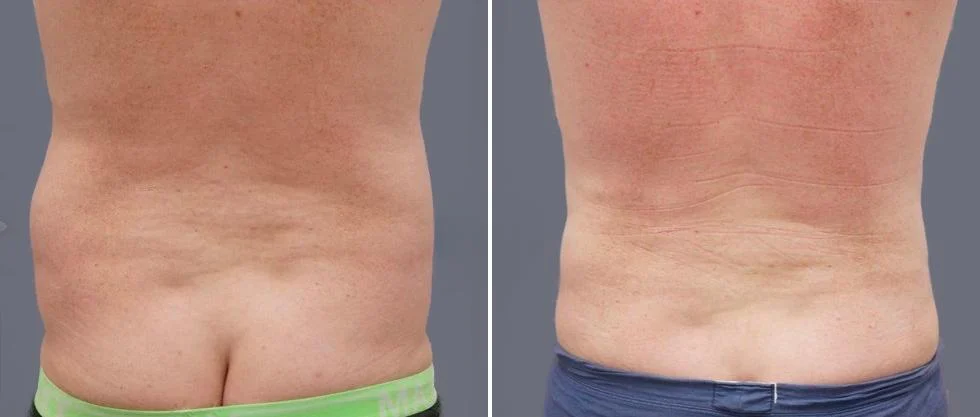 vaser back liposcution male pre2024 018 before and after before and after