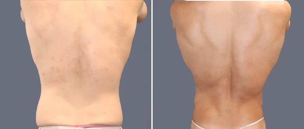vaser back liposcution male pre2024 019 before and after before and after