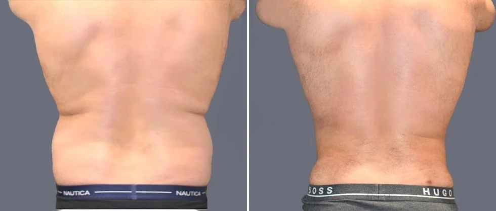 vaser back liposcution male pre2024 020 before and after before and after