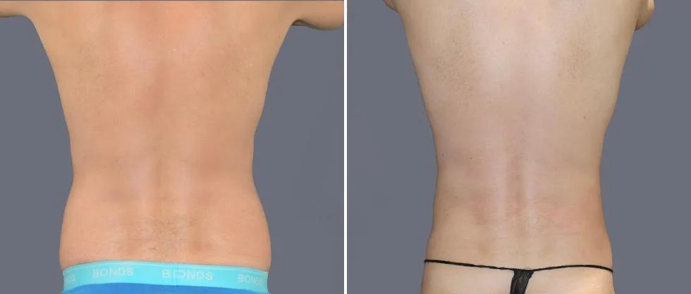vaser back liposcution male pre2024 022 before and after before and after