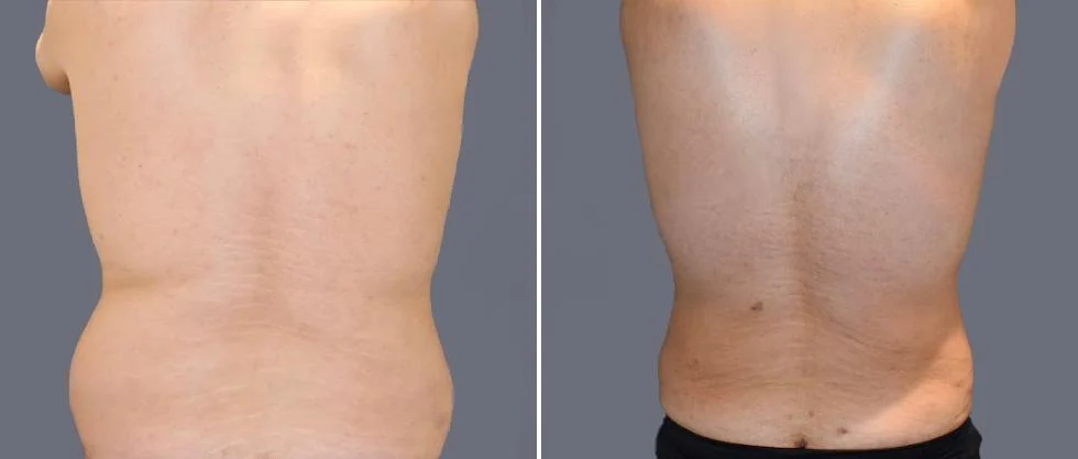 vaser back liposcution male pre2024 024 before and after before and after