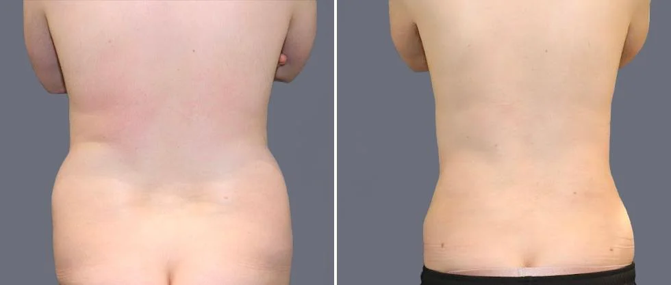 vaser back liposcution male pre2024 026 before and after before and after