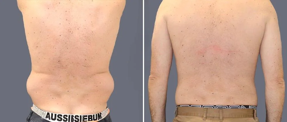 vaser back liposcution male pre2024 027 before and after before and after