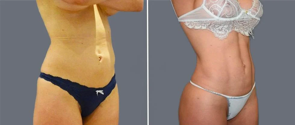 vaser hi definition female pre2024 001 before and after before and after