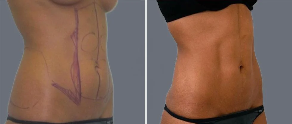 vaser hi definition female pre2024 004 before and after before and after