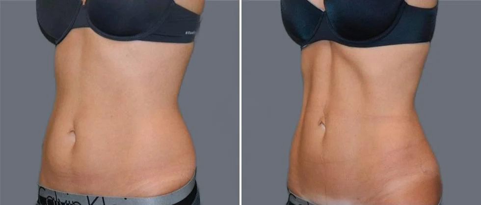 vaser hi definition female pre2024 006 before and after before and after