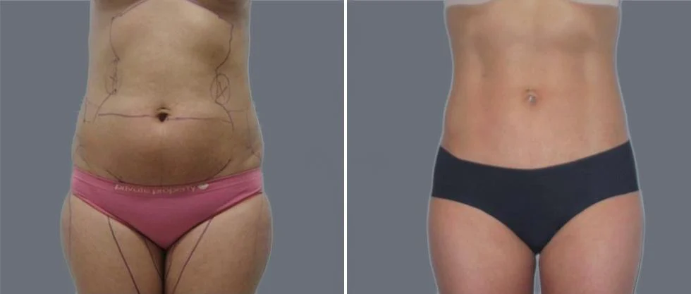 vaser hi definition female pre2024 009 before and after before and after