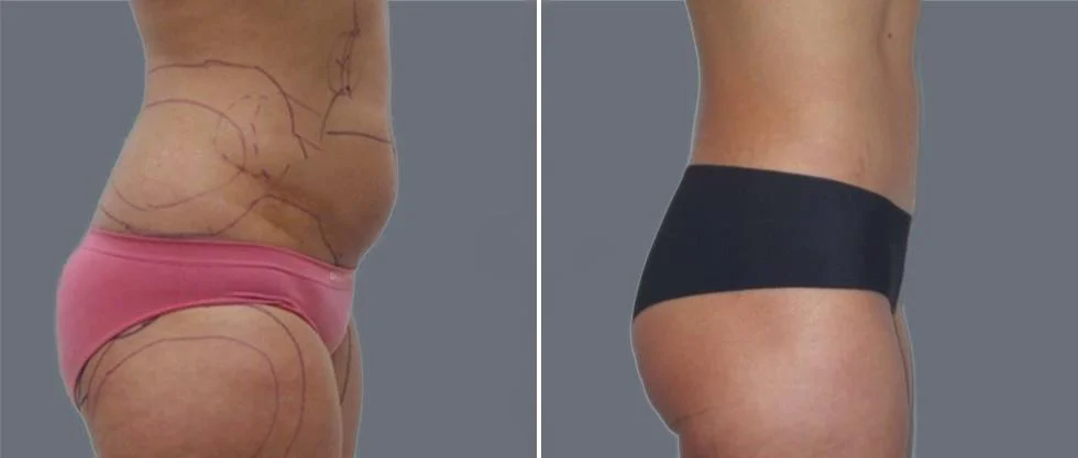 vaser hi definition female pre2024 010 before and after before and after