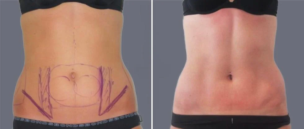 vaser hi definition female pre2024 014 before and after before and after