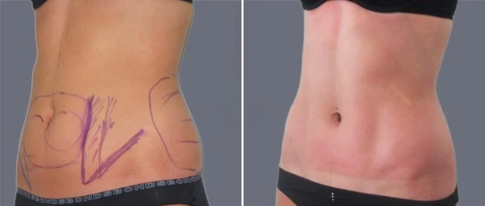 vaser hi definition female pre2024 015 before and after before and after