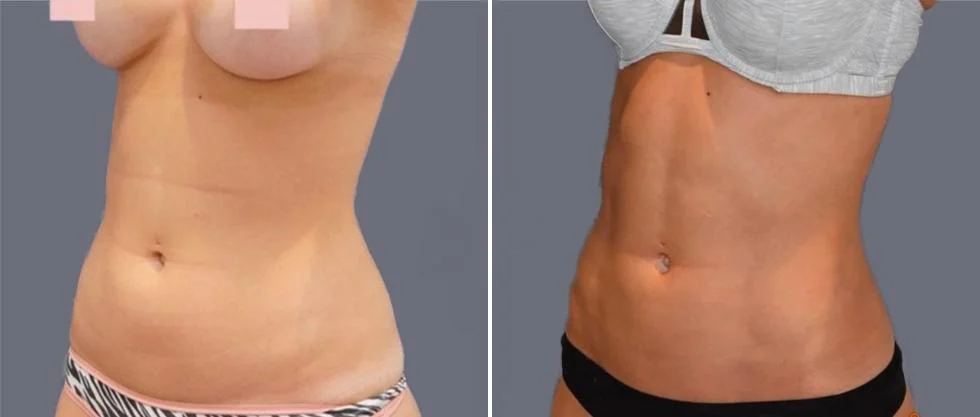 vaser hi definition female pre2024 016 before and after before and after