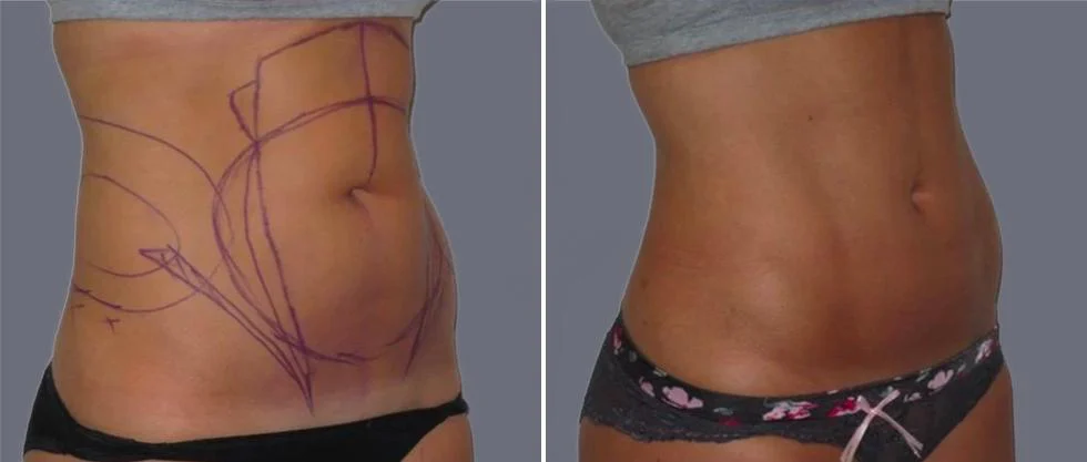 vaser hi definition female pre2024 018 before and after before and after