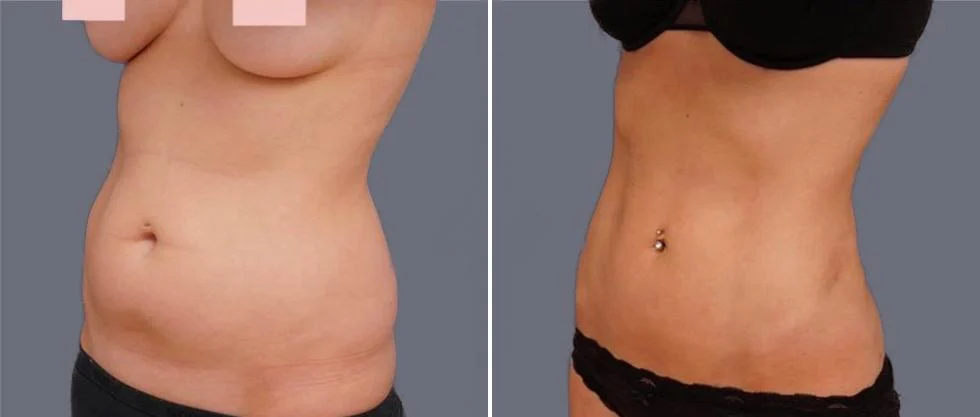 vaser hi definition female pre2024 019 before and after before and after