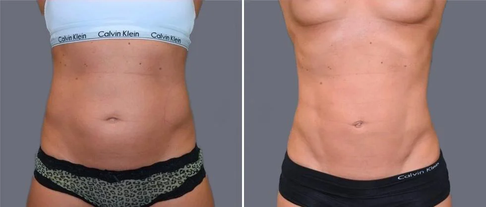 vaser hi definition female pre2024 024 before and after before and after