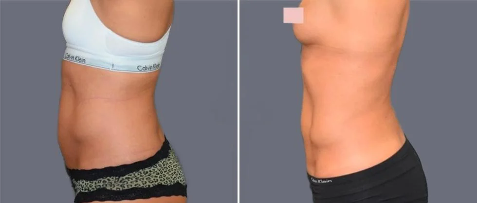vaser hi definition female pre2024 025 before and after before and after