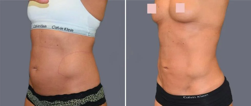 vaser hi definition female pre2024 026 before and after before and after