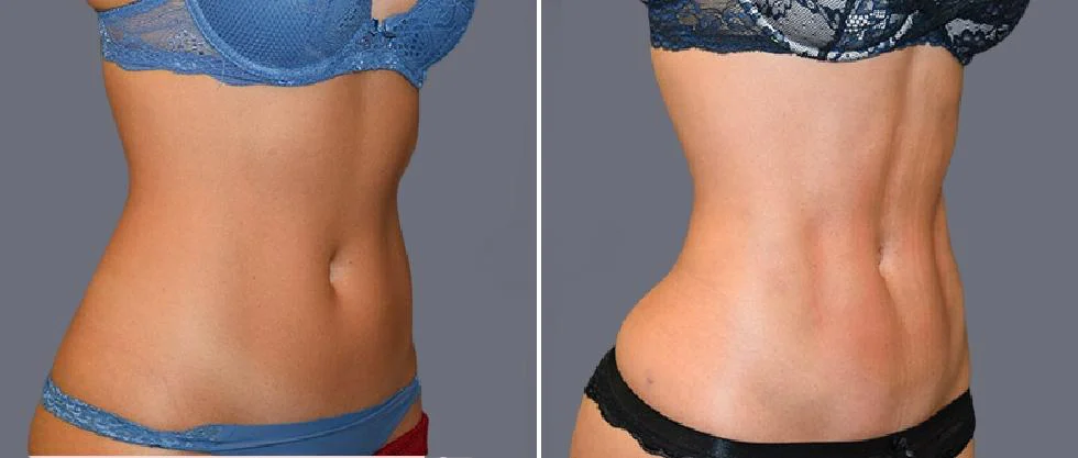vaser hi definition female pre2024 029 before and after before and after