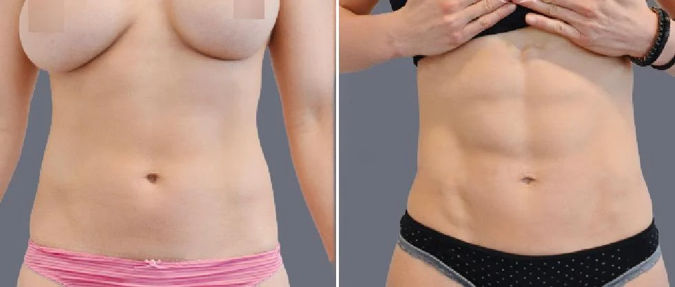 vaser hi definition female pre2024 030 before and after before and after