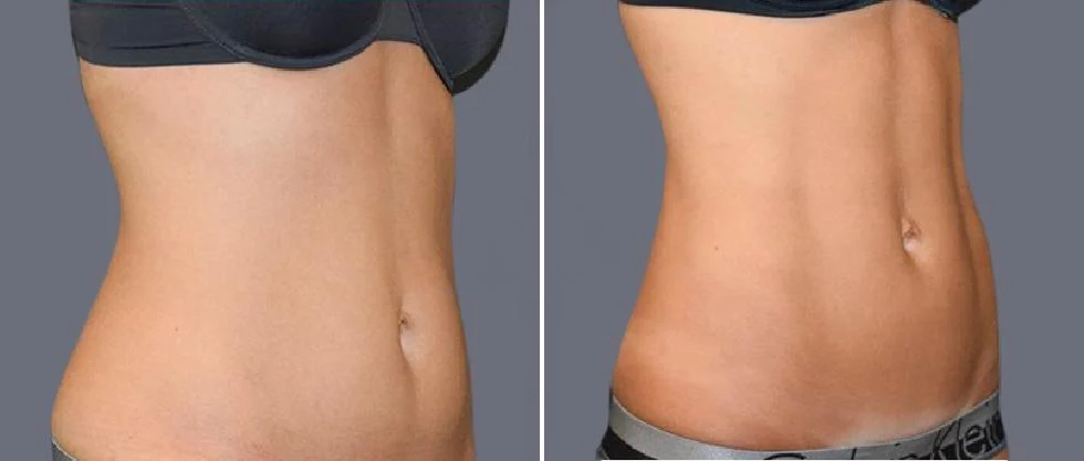 vaser hi definition female pre2024 032 before and after before and after