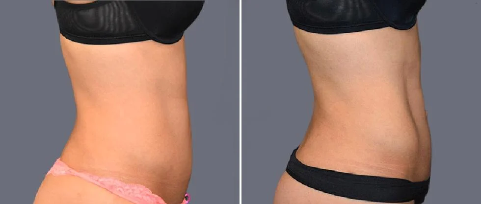 vaser hi definition female pre2024 035 before and after before and after