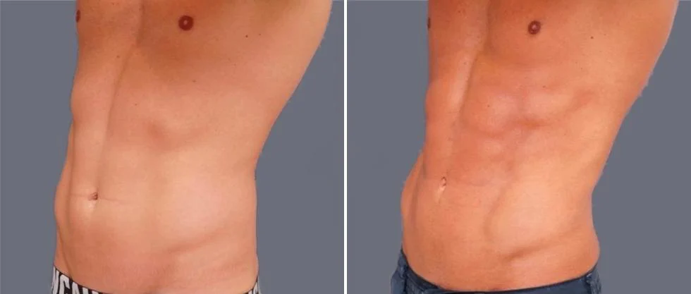 vaser hi definition pre2024 002 before and after before and after