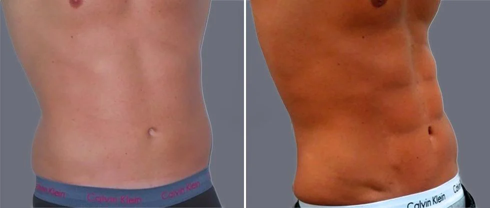 vaser hi definition pre2024 003 before and after before and after