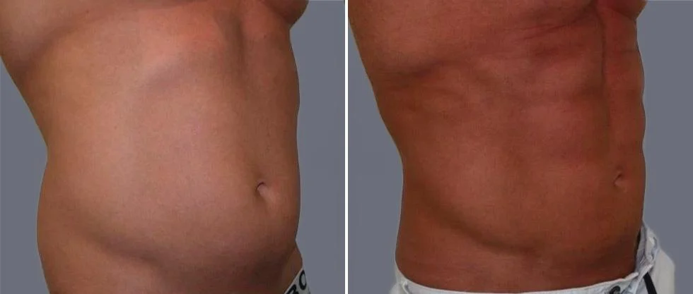 vaser hi definition pre2024 006 before and after before and after