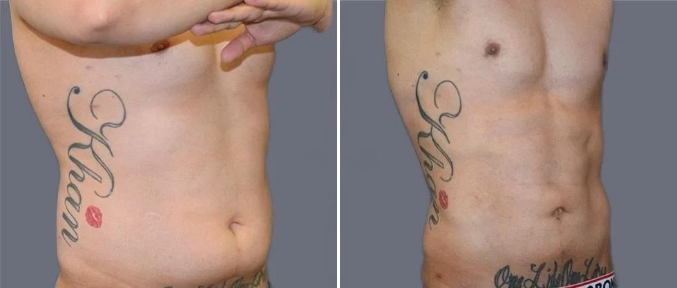 vaser hi definition pre2024 007 before and after before and after