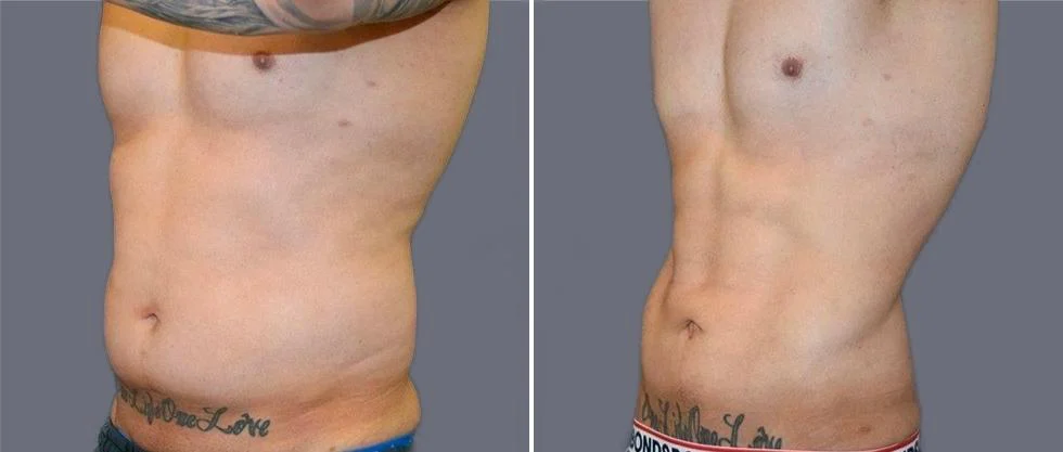 vaser hi definition pre2024 008 before and after before and after