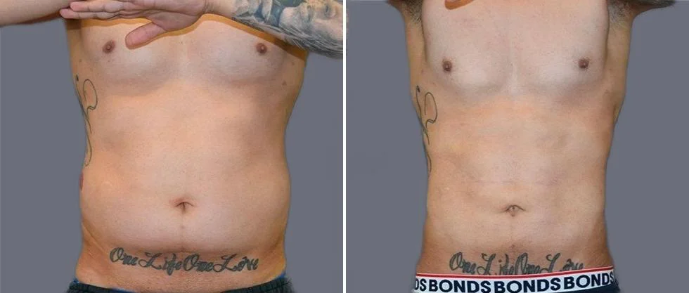 vaser hi definition pre2024 009 before and after before and after