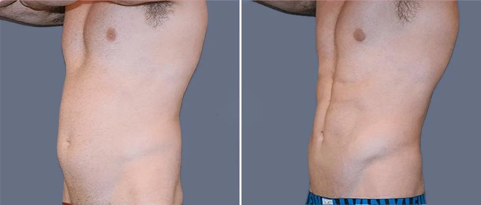 vaser hi definition pre2024 010 before and after before and after