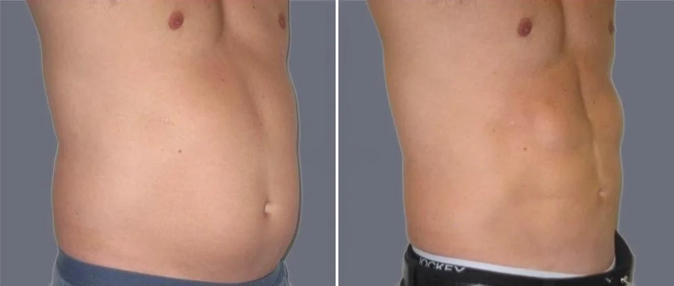 vaser hi definition pre2024 012 before and after before and after