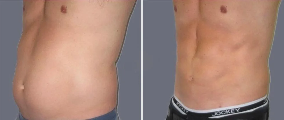 vaser hi definition pre2024 013 before and after before and after