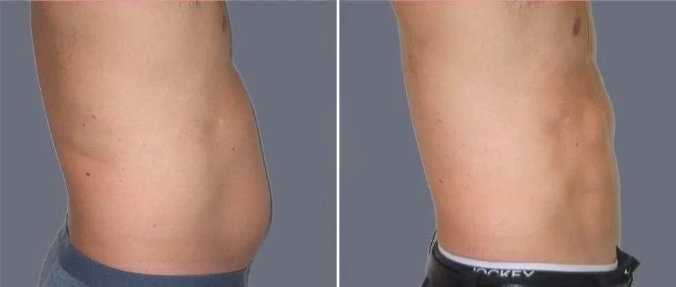 vaser hi definition pre2024 014 before and after before and after