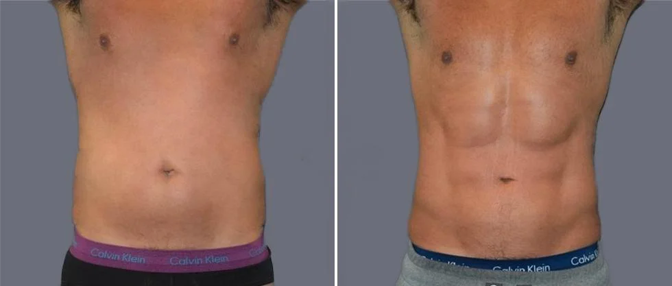 vaser hi definition pre2024 015 before and after before and after