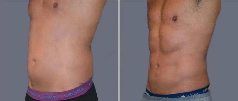 vaser hi definition pre2024 016 before and after before and after