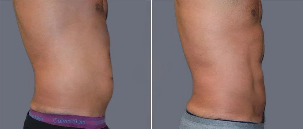 vaser hi definition pre2024 017 before and after before and after