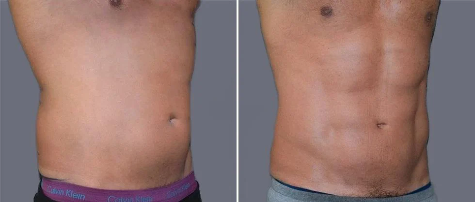 vaser hi definition pre2024 018 before and after before and after