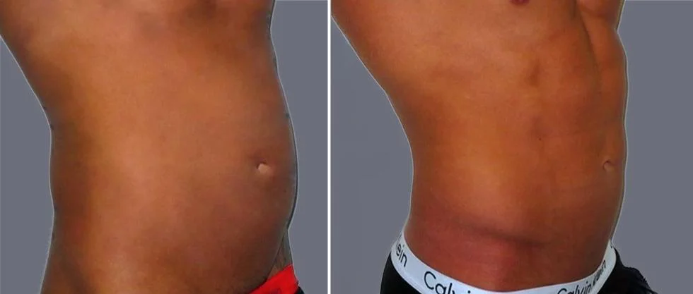 vaser hi definition pre2024 019 before and after before and after