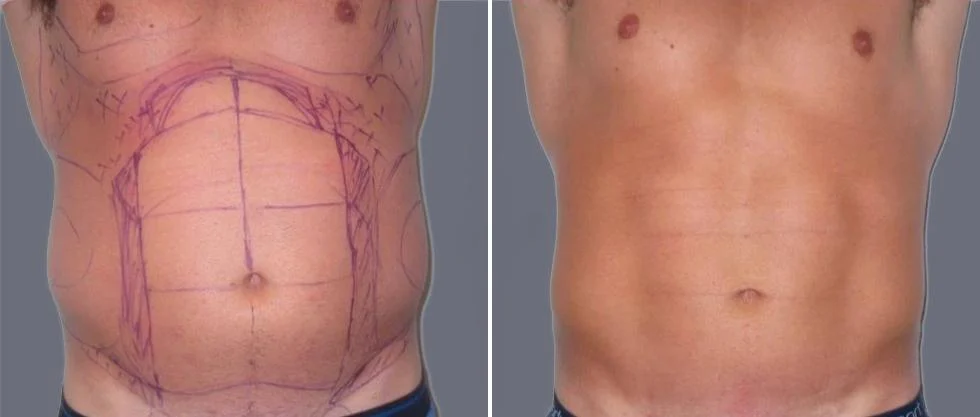 vaser hi definition pre2024 020 before and after before and after
