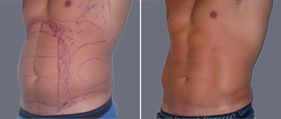 vaser hi definition pre2024 021 before and after before and after