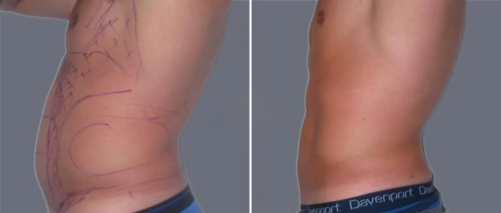 vaser hi definition pre2024 023 before and after before and after