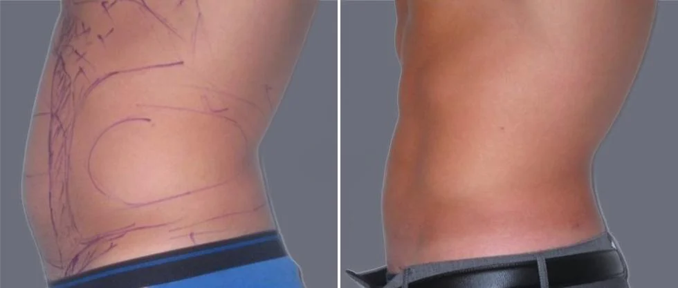 vaser hi definition pre2024 024 before and after before and after