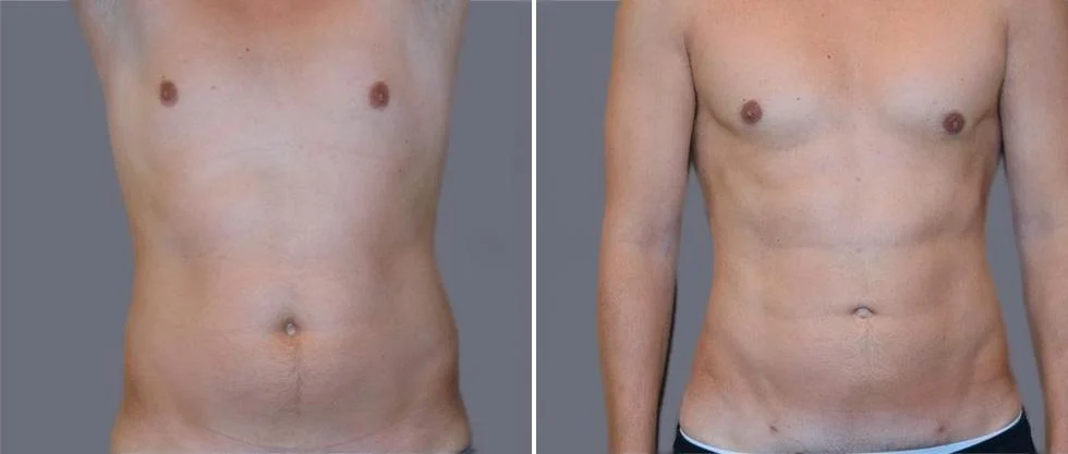 vaser hi definition pre2024 026 before and after before and after