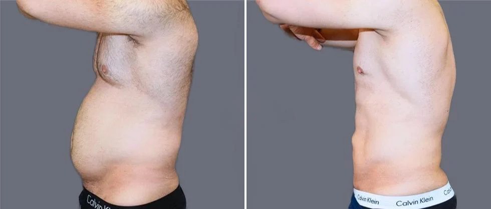 vaser hi definition pre2024 029 before and after before and after