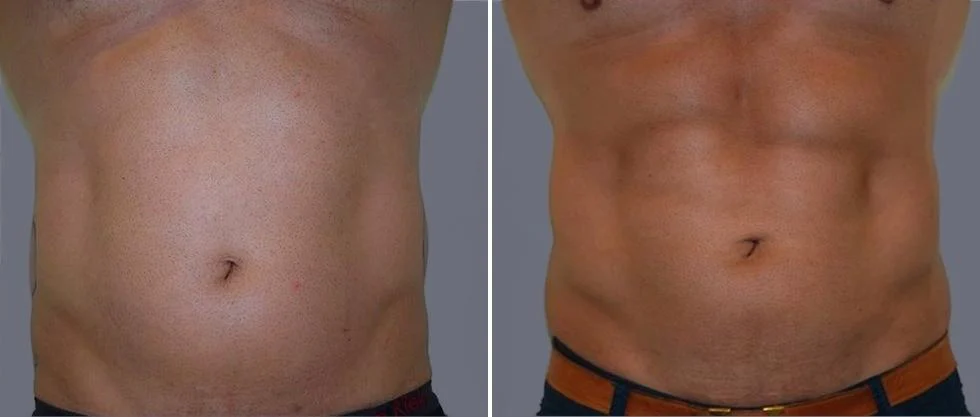 vaser hi definition pre2024 031 before and after before and after