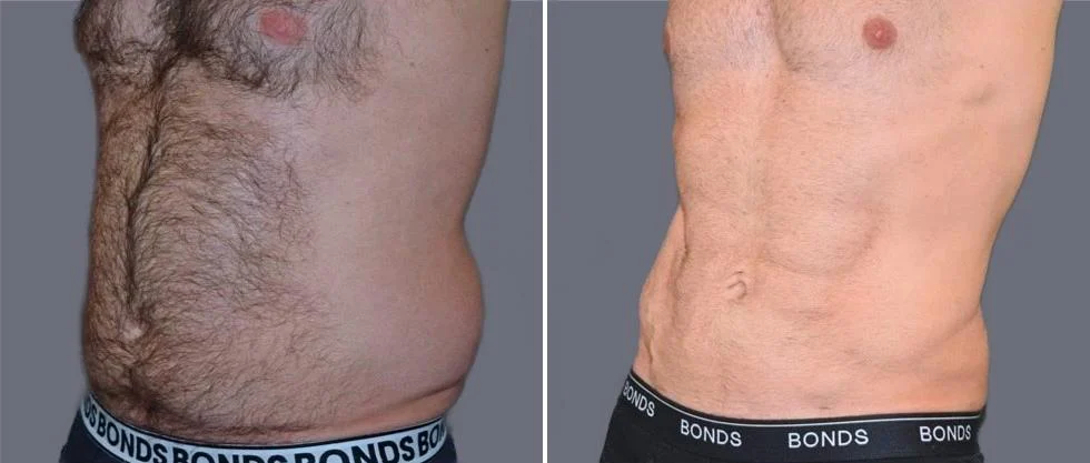 vaser hi definition pre2024 032 before and after before and after