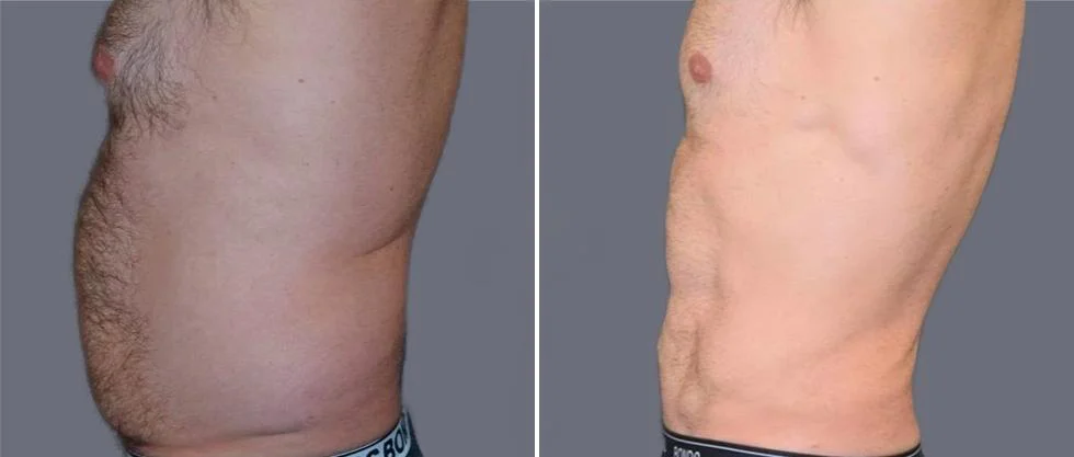 vaser hi definition pre2024 033 before and after before and after