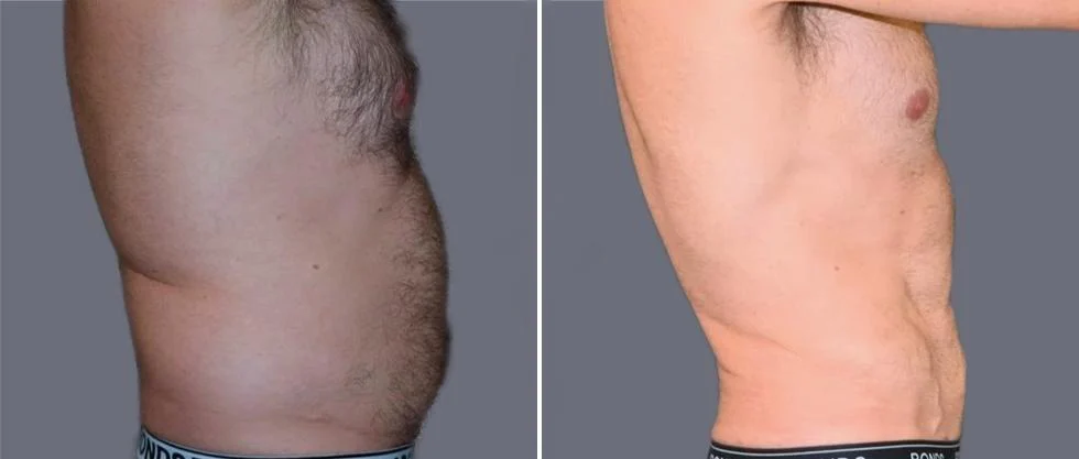 vaser hi definition pre2024 034 before and after before and after